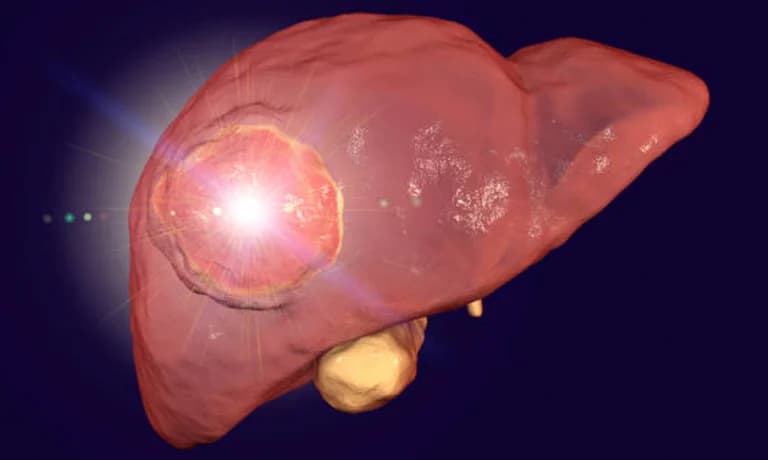 Karaciğerin İyi Huylu Kitleleri