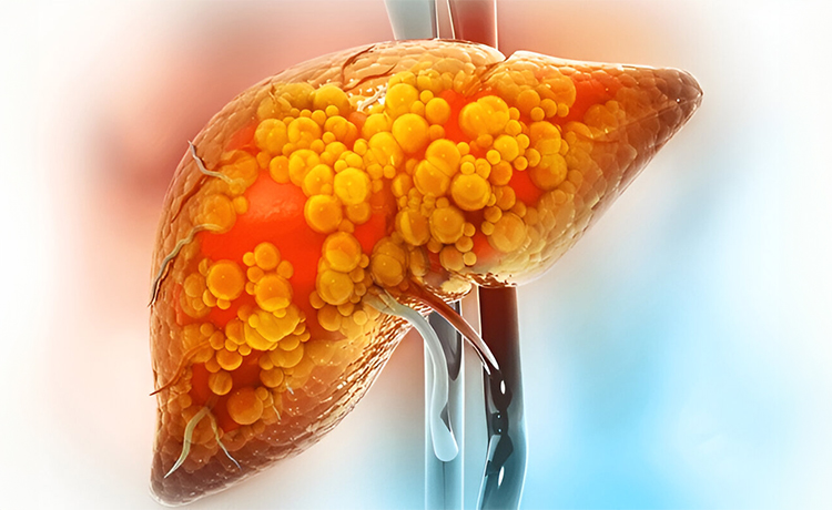 Karaciğer Yağlanması Nedir?